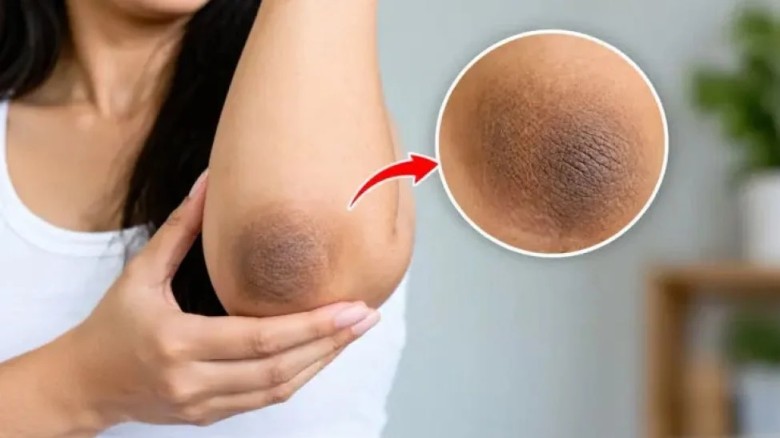 কনুইয়ের কালচে দাগ, কী কারণে হয় ও করণীয়